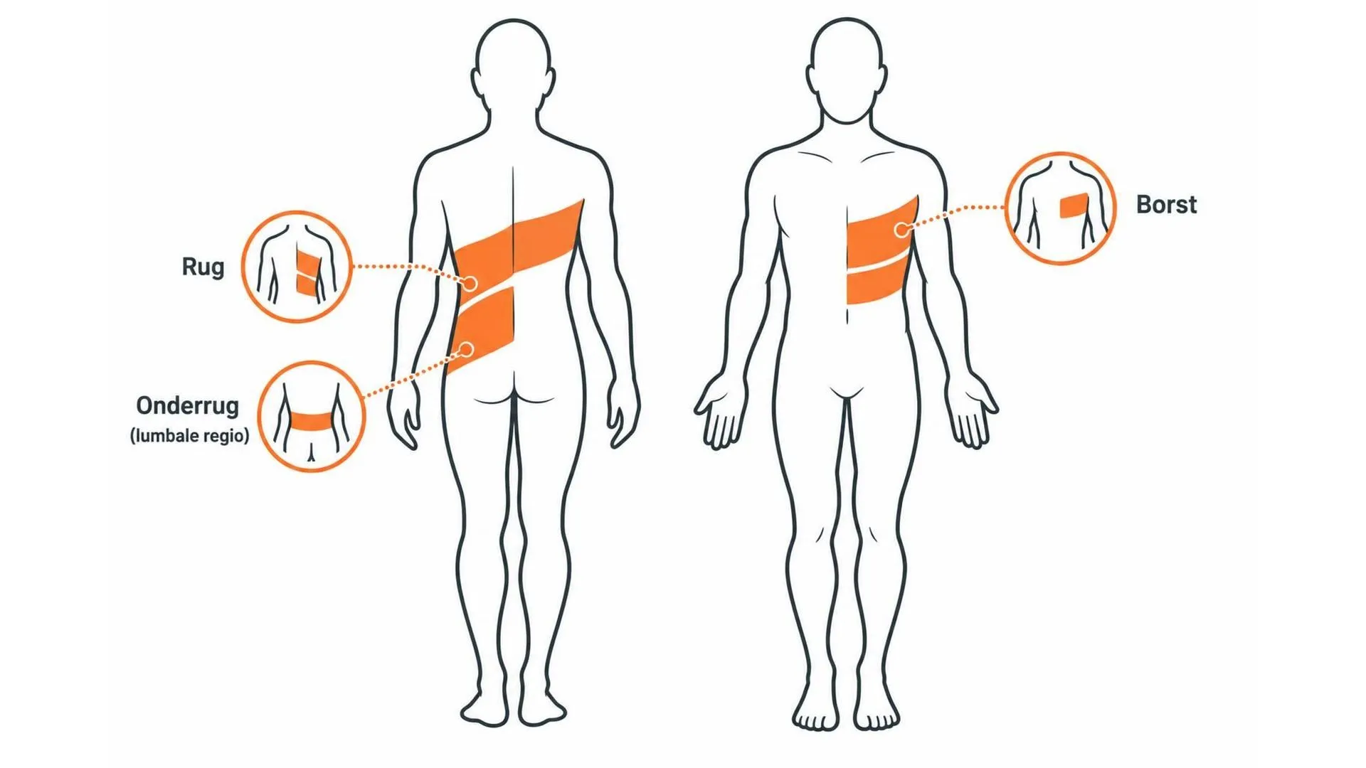 Lichaamsdiagram dat toont waar gordelroos het vaakst optreedt: borst, rug en onderrug, meestal aan één kant van het lichaam