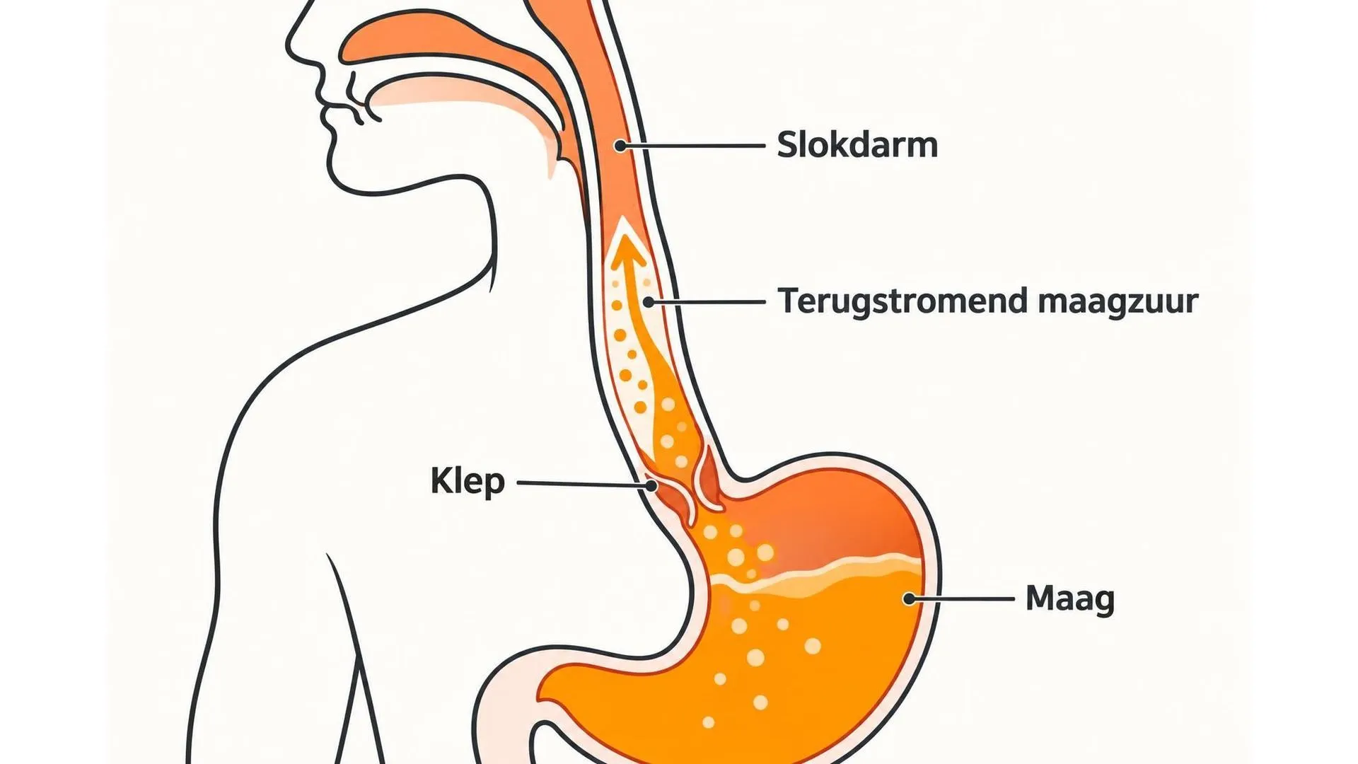 Doorsnede van slokdarm en maag met de klep die bij reflux niet goed sluit, waardoor maagzuur terugstroomt
